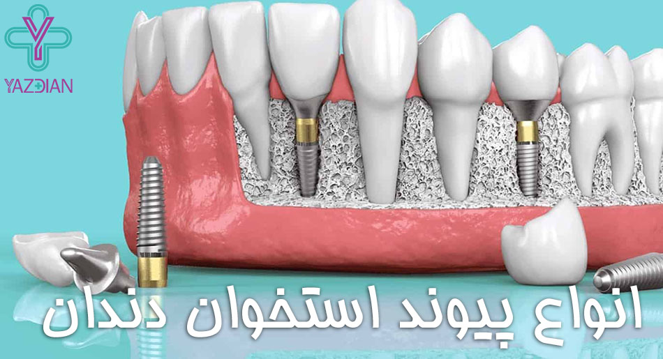 انواع پیوند استخوان دندان؛ مزایا و معایب آن